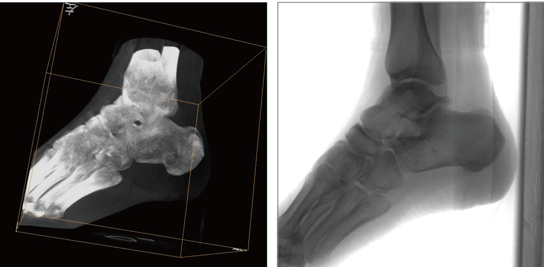 天弓PLX7500骨科三維C形臂影像 天弓PLX7500骨科三維C形臂影像