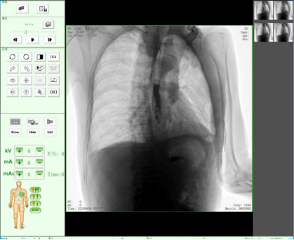 U型臂DR界面 U型臂DR界面