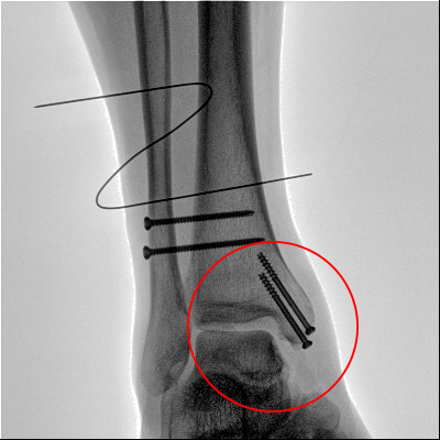 【醫療科普】之內踝骨折 【醫療科普】之內踝骨折