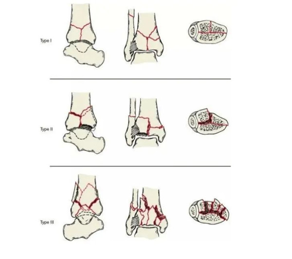 【醫療科普】Pilon骨折 【醫療科普】Pilon骨折