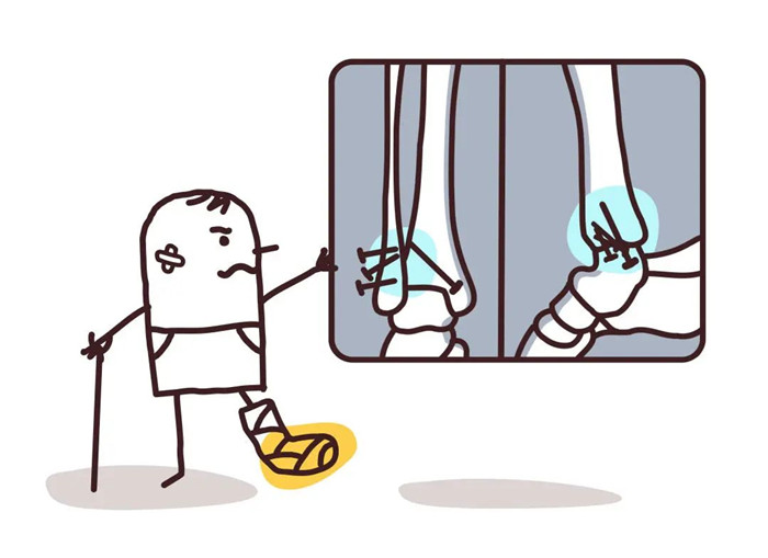 【醫療科普】:關節面不能有塌陷 【醫療科普】:關節面不能有塌陷