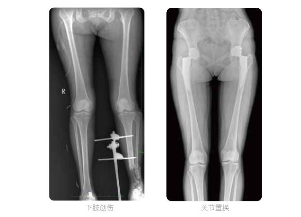 動態DR的雙下肢臨床影像 動態DR的雙下肢臨床影像