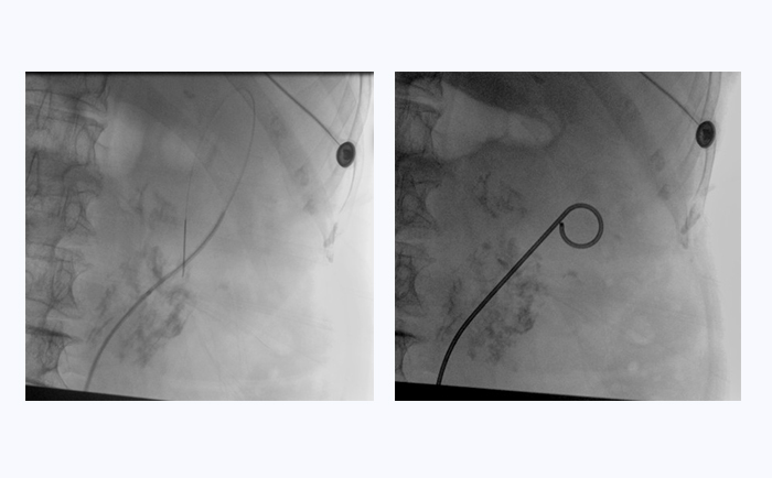 大平板一體式C形臂臨床圖像 大平板一體式C形臂臨床圖像